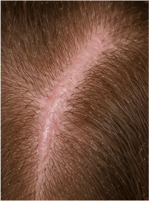 Illustration of hair sometimes stop growing on a scar for the question "Why does hair sometimes stop growing on a scar?"